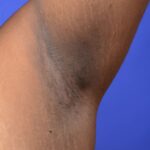 Acanthosis nigricans on the armpit