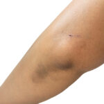 Acanthosis nigricans on the elbow