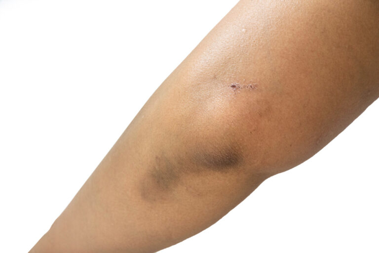 Acanthosis nigricans on the elbow