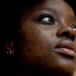 Acne Rosacea on the face of an African American Woman