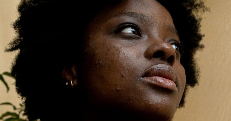 Acne Rosacea Acne Rosacea on the face of an African American Woman