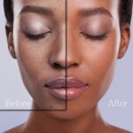 Dermal Fillers for skin of color