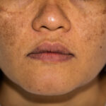 Drug-induced Pigmentation