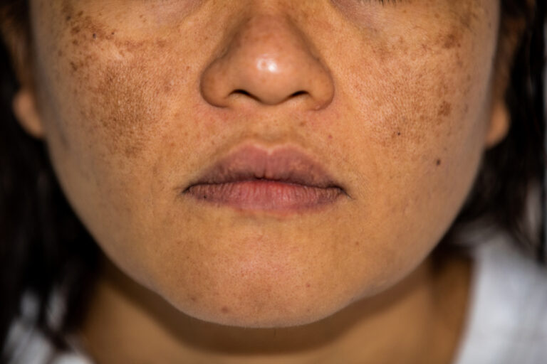 Drug-induced Pigmentation