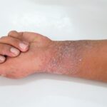 Eczema skin condition for skin of color