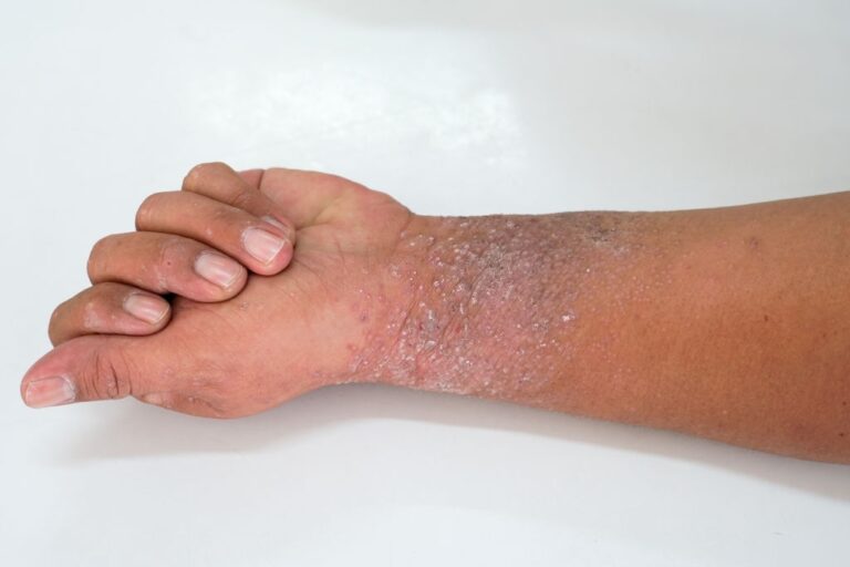 Eczema skin condition for skin of color