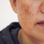 Melasma on skin of color