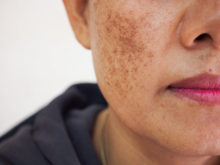 Melasma Melasma on skin of color