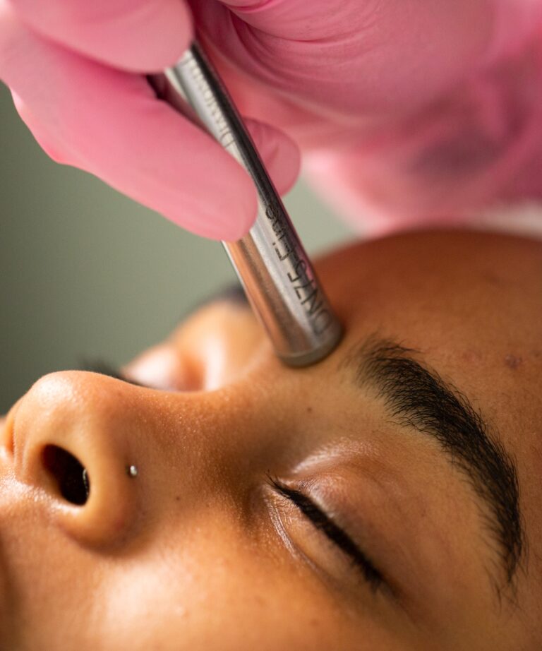 Microdermabrasion treatment for skin of color