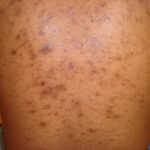 What Causes Post Inflammatory Hyperpigmentation on Dark Skin