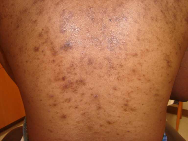 What Causes Post Inflammatory Hyperpigmentation on Dark Skin