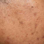 Photodamage treatment