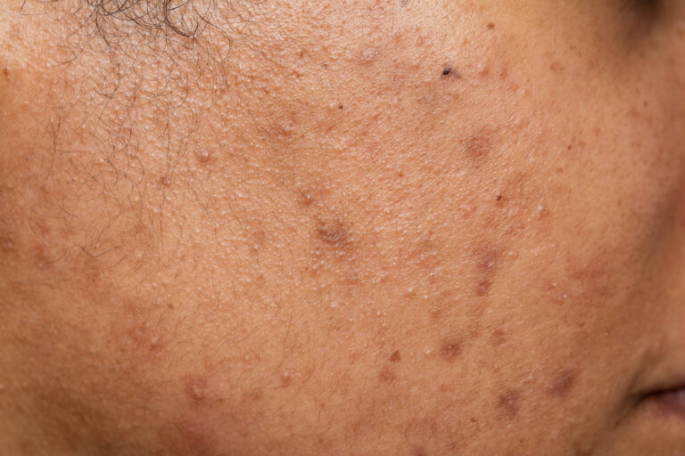 Photodamage treatment