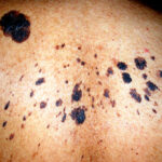 Skin cancer on skin of color