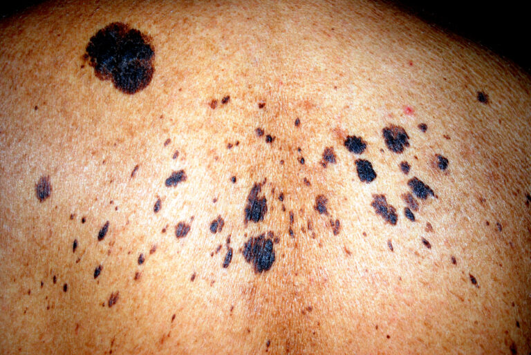 Skin cancer on skin of color