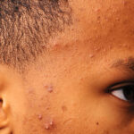Acne Vulgaris of the face of an African American