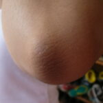 Elbow Hyperkeratosis on skin of color