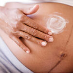 How to Treat Melasma After Pregnancy