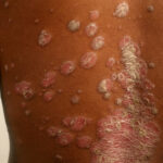 Psoriasis on skin of color