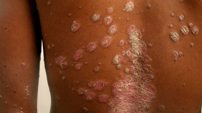 Psoriasis on skin of color