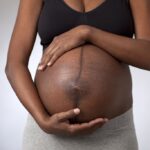 THE EFFECTS OF PREGNANCY ON THE SKIN AND HAIR OF WOMEN OF COLOR