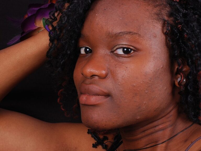 Types Of Acne Types Of Acne of skin of color