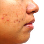 What Causes Acne