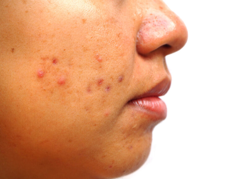 What Causes Acne