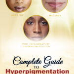 Complete guide to hyperpigmentation pdf download
