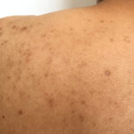 How to treat Acne "back acne"