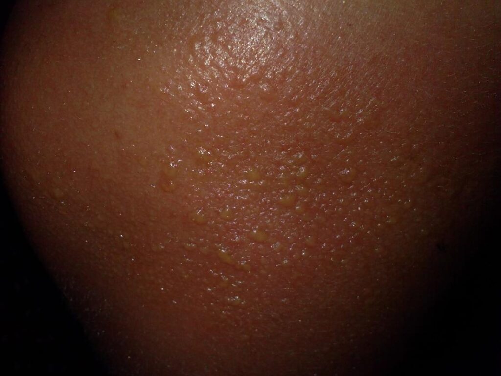 Medication and Sun Sensitivity