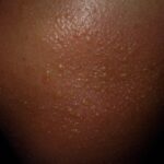 Medication and Sun sensitivity on skin of color