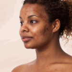 How to Get Rid of Acne Scars on the face